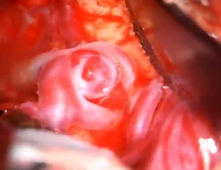 Mediabifurkationsaneurysma
