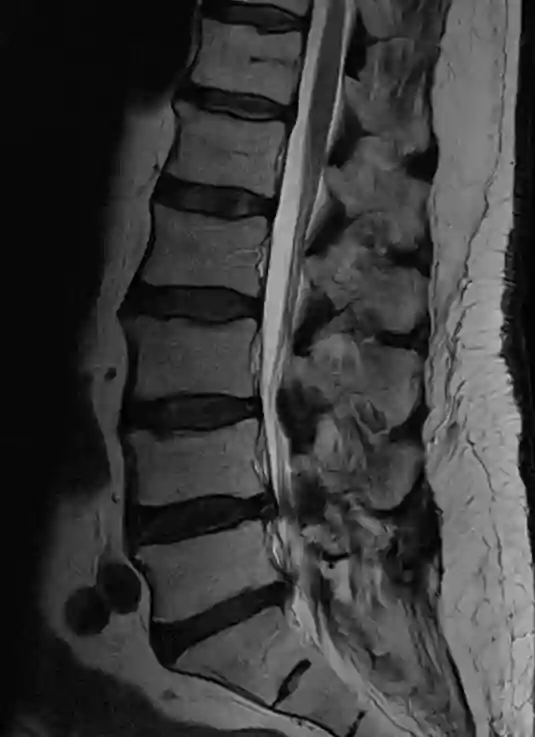 Morbus Baastrup MRI