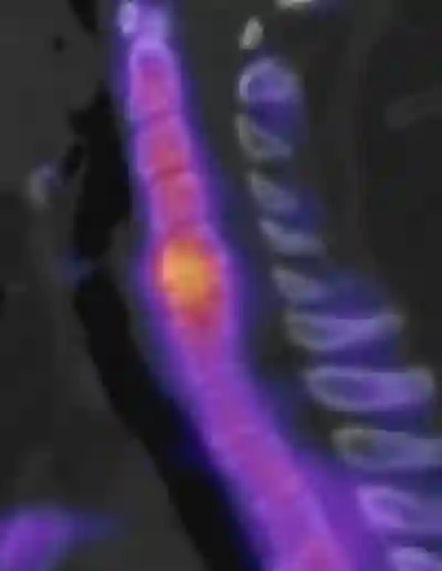 SPECT/CT HWS Osteochondrose
