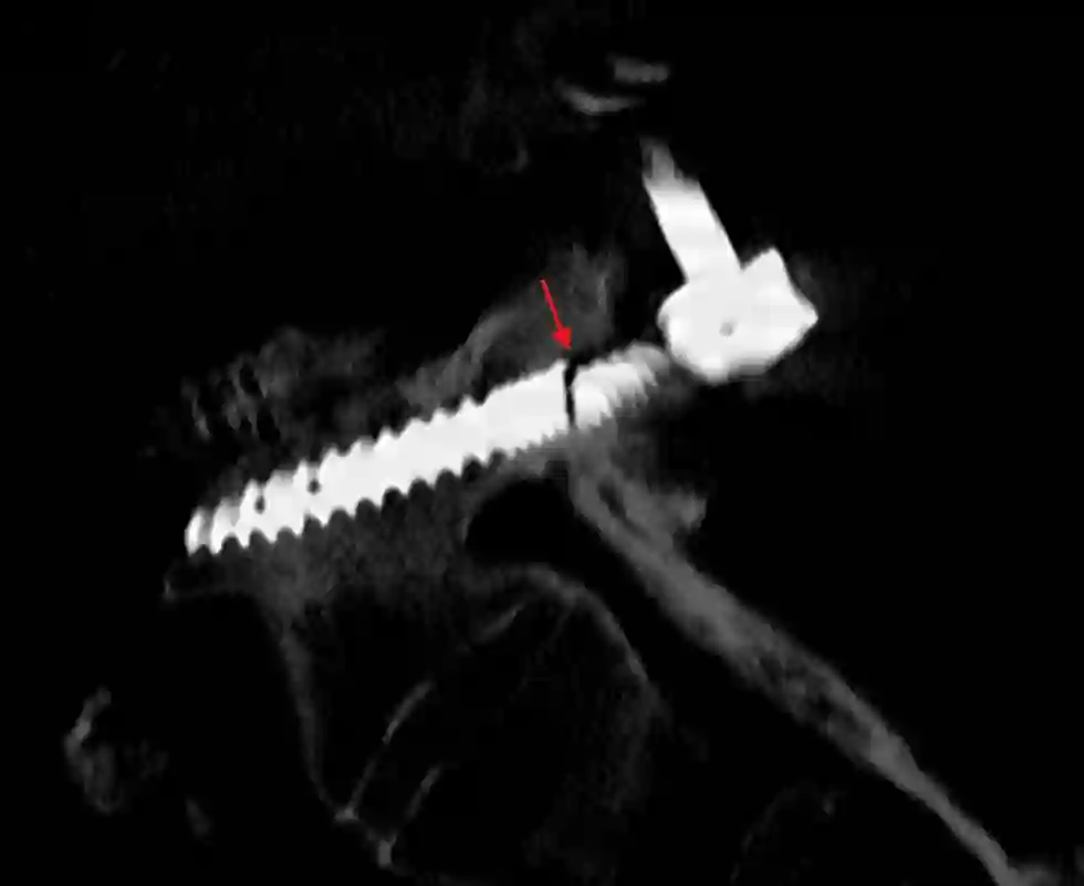 Gebrochene Pedikelschraube CT