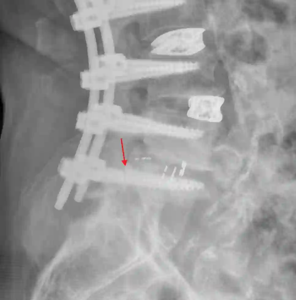 Gebrochene Pedikelschraube Röntgen