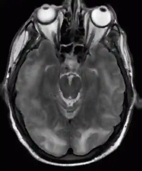 PRES Syndrom MRT