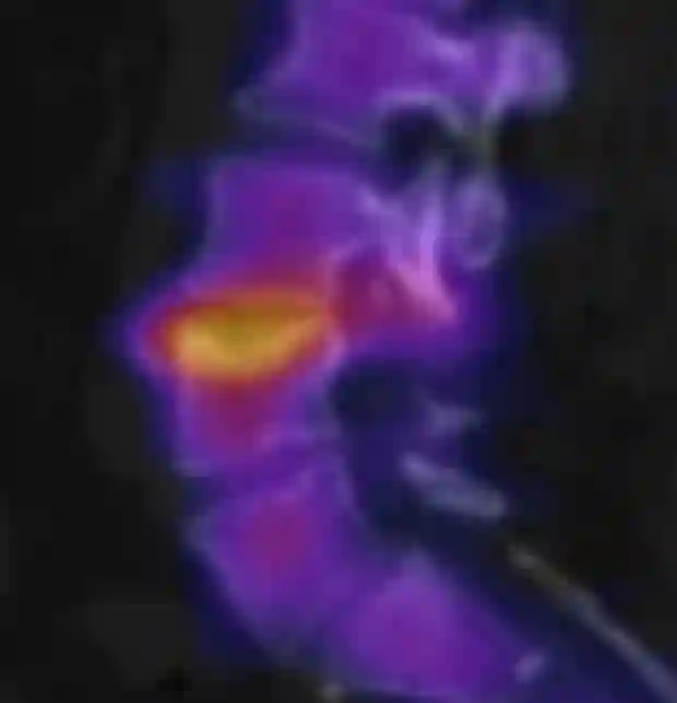 SPECT/CT Schmorl Knoten