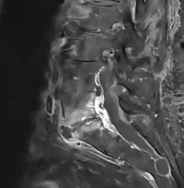 Spondylodiscitis MRT