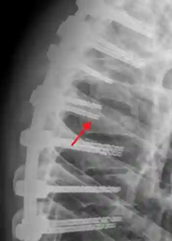 Indexschraube Röntgen