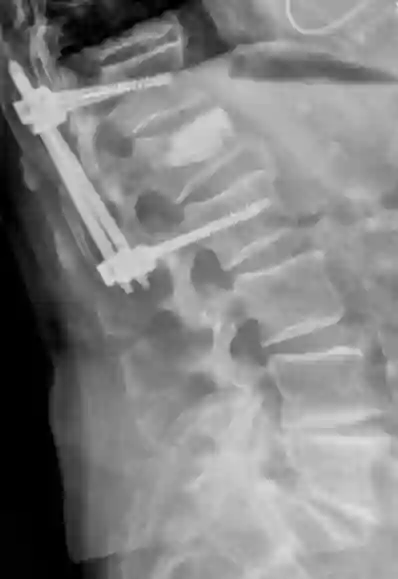 Überbrückungsspondylodese Röntgen