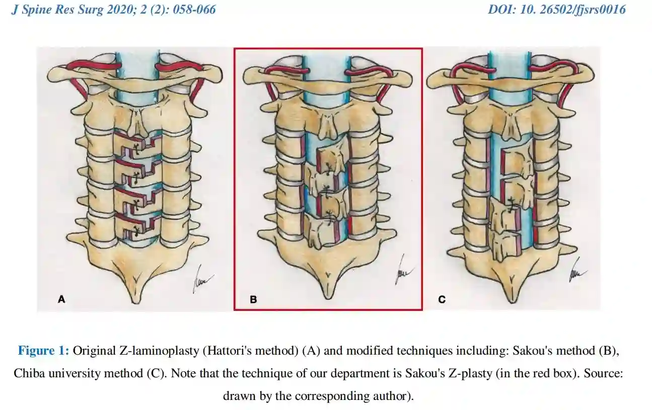 Z-Laminoplasty