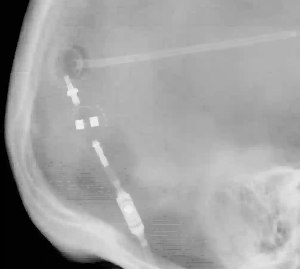 Sophysa Polaris Shunt im Röntgen