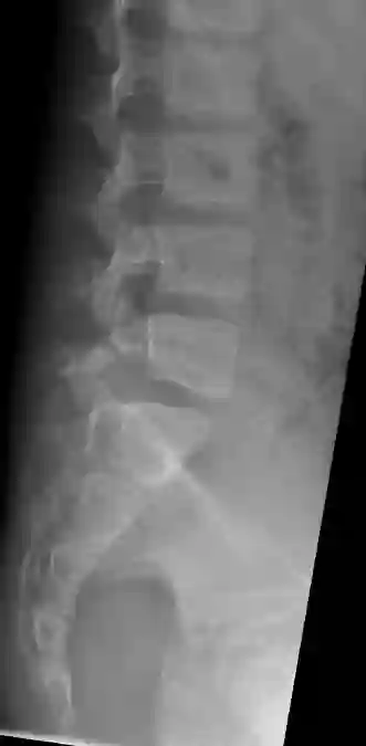 Spondylolyse im Röntgen