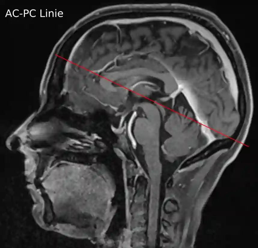 AC PC Linie im sagittalen MRi