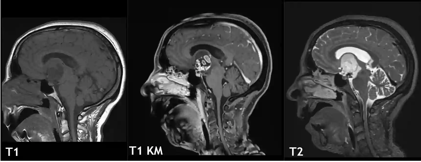 Kraniopharyngeom im MRI