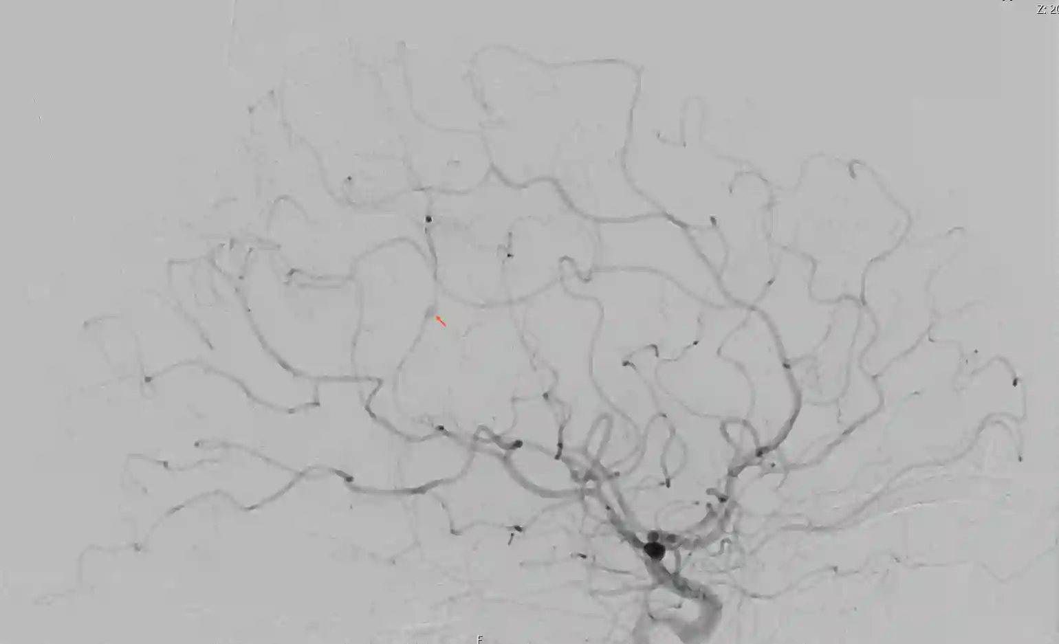 Fusiformes Aneurysma in einer lateralen Ansicht einer DSA