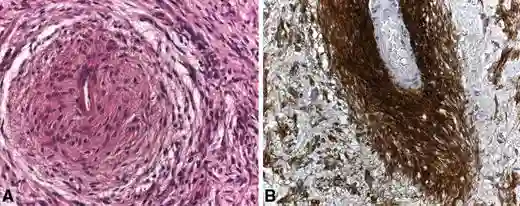 Histopathologie angiozentrisches Gliom