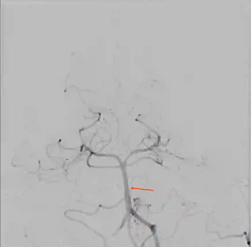 Angiographie der Arteria basilaris