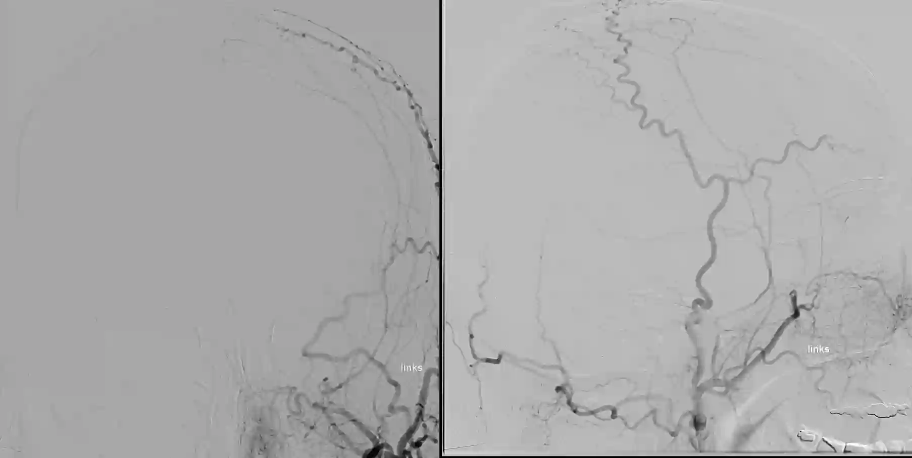 Angiographie arteria carotis externa