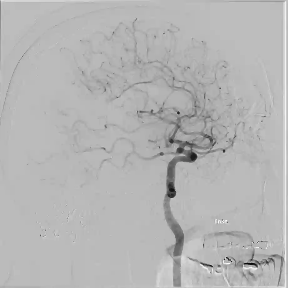 ICA Angiographie lateral