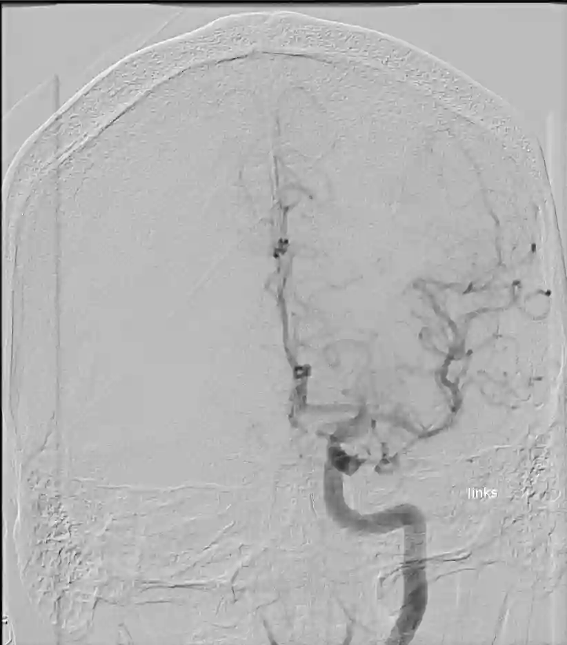 ICA Angiographie AP