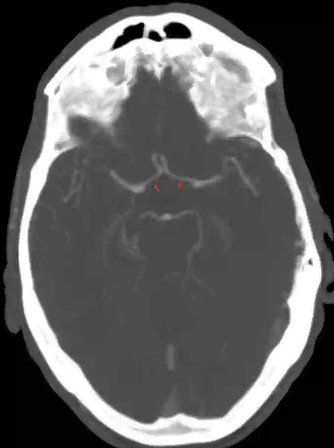 Arteria cerebri anterior in der CT Angiographie