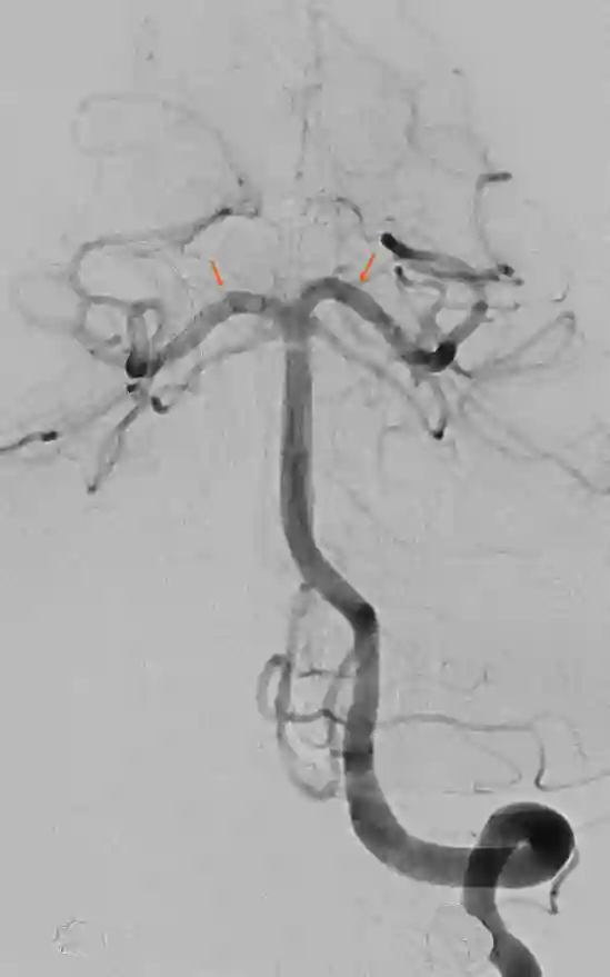 Arteria cerebri posterior DSA Angiographie
