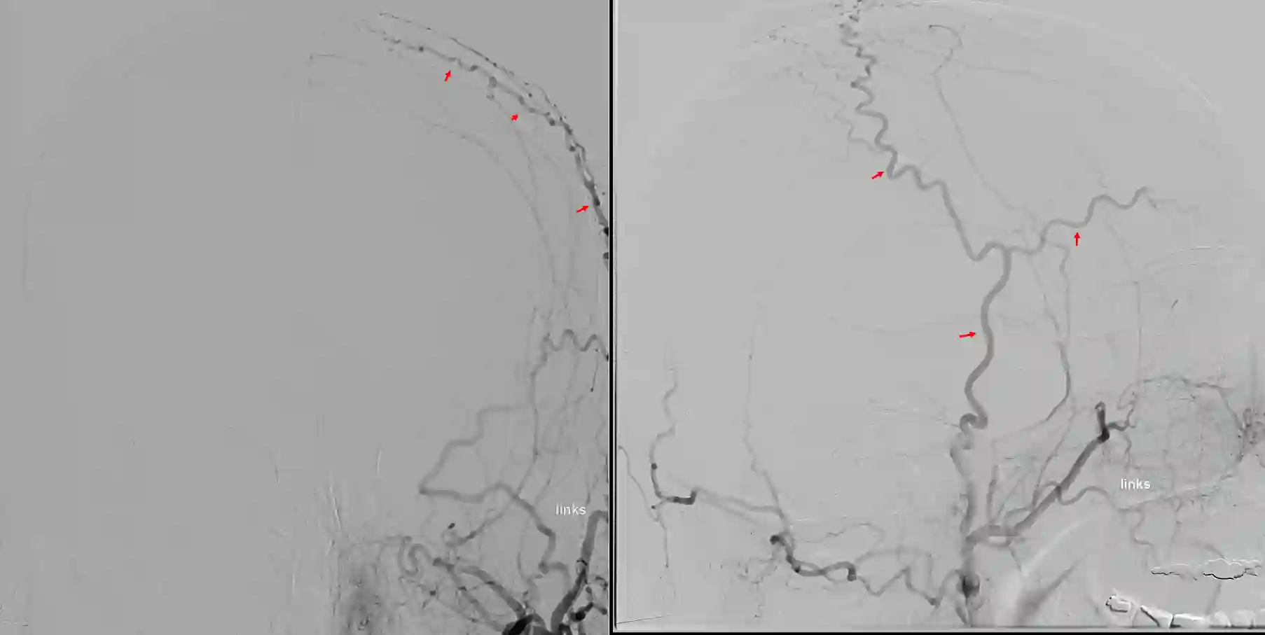 Arteria temporalis superficialis in einer Angiographie.