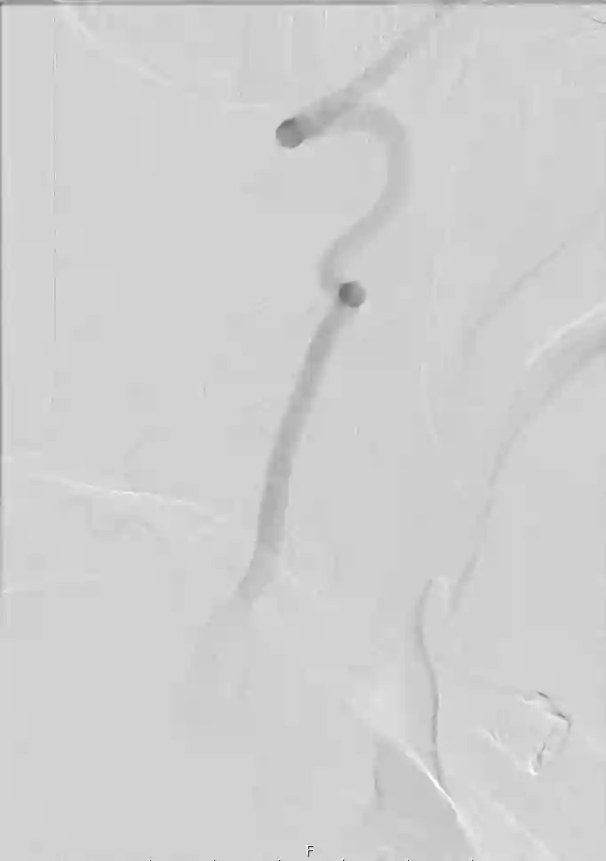 Arteria vertebralis in einer digitalen Substraktionsangiographie