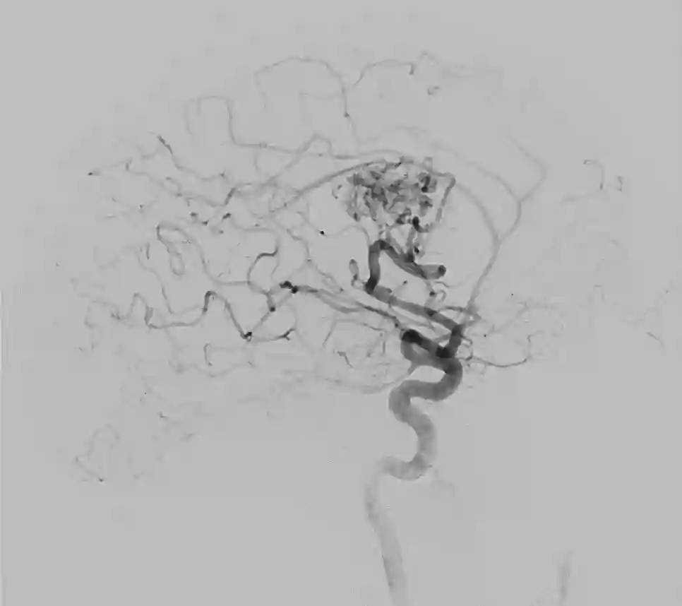 Angiographie einer arteriovenösen Malformation
