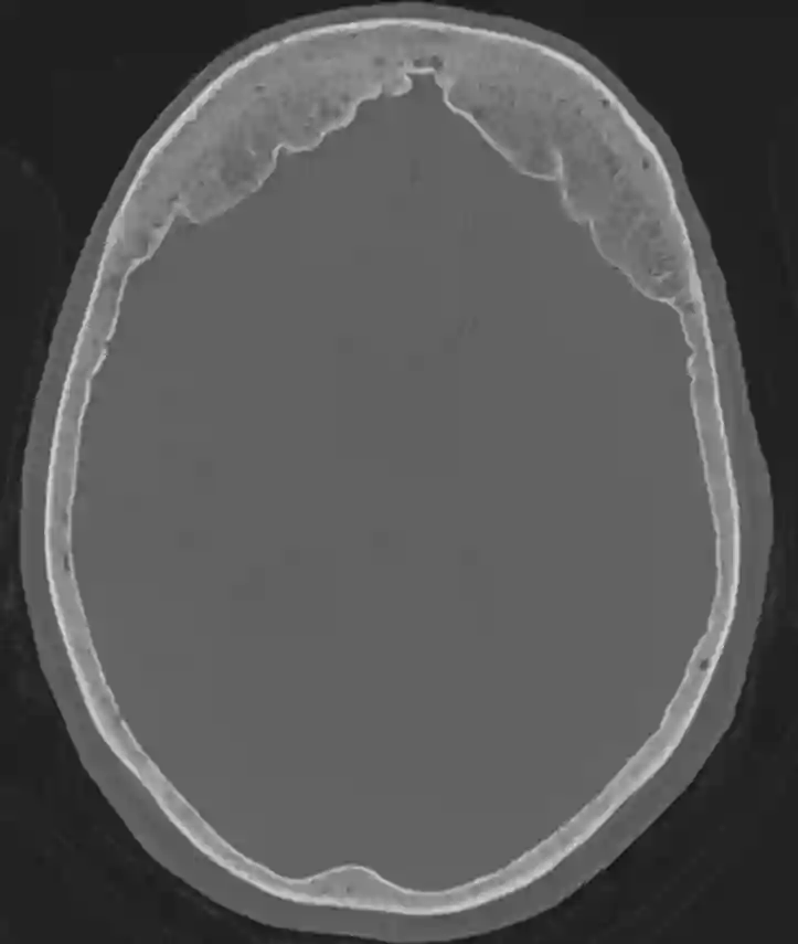 Bifrontale Hyperostose im CT