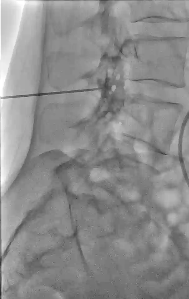 Blutpatch Applikation unter Durchleuchtung