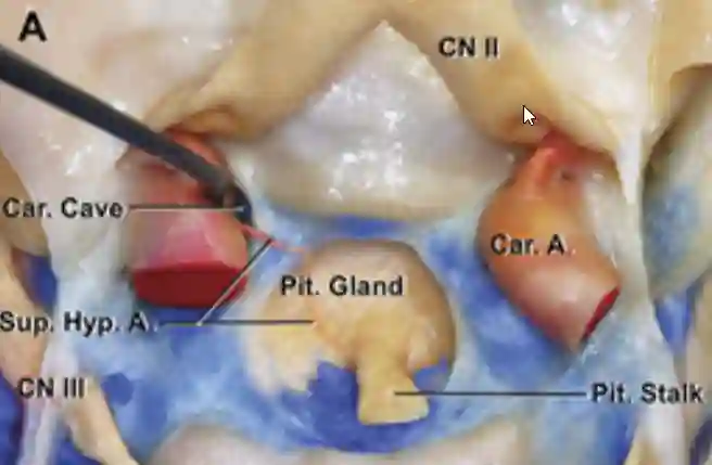 Anatomische Darstellung der Carotid cave