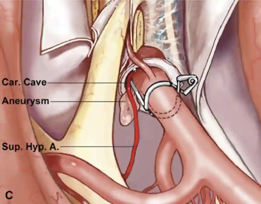 Schematische Abbildung eines Carotid cave Aneurysmas