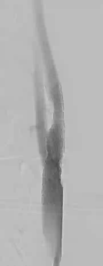 Carotis Stent in der Angiographie