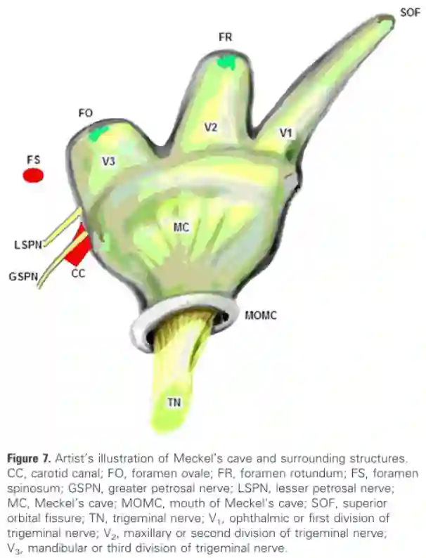 Cavum Meckeli Schema