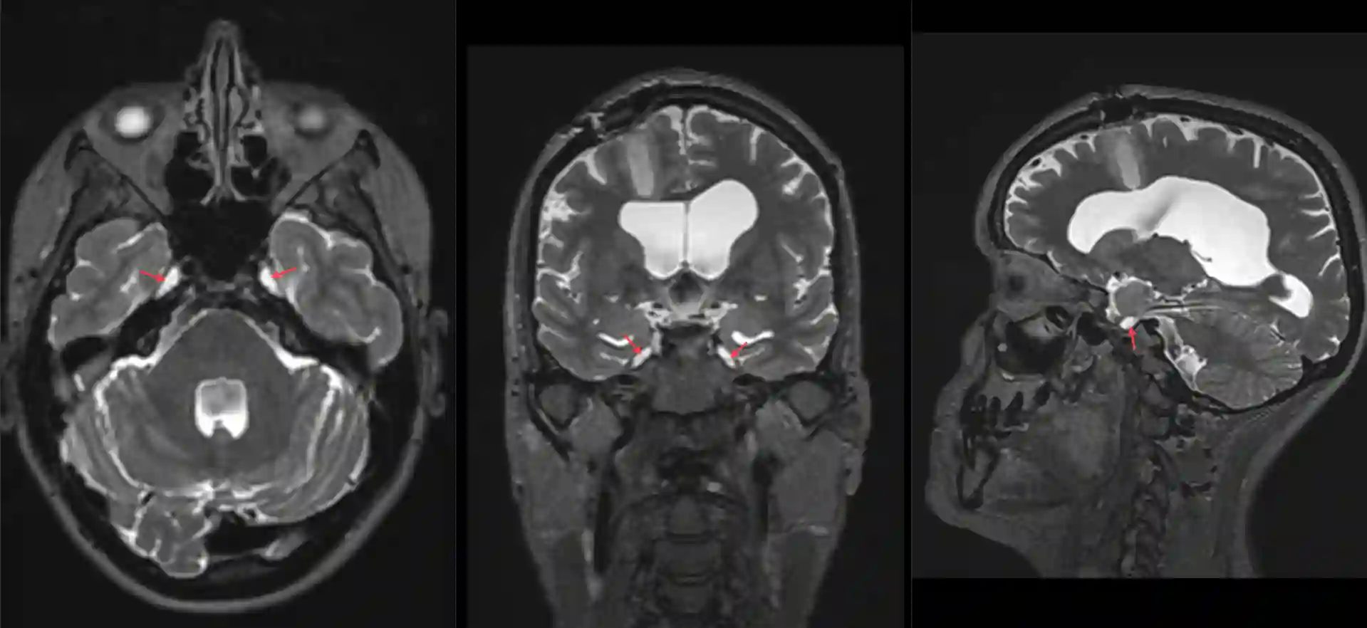 Cavum Meckeli im MRI
