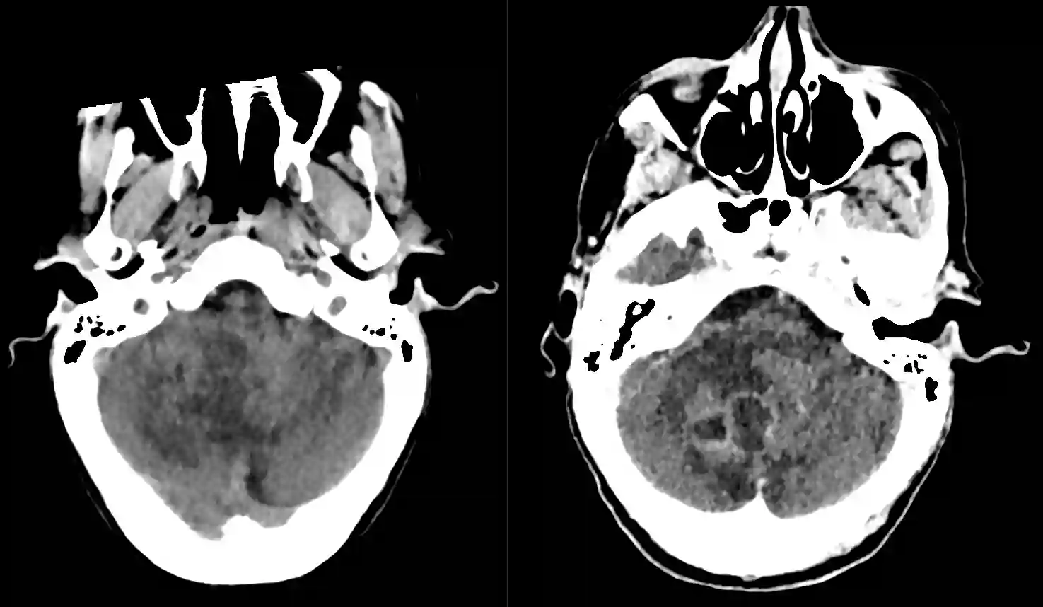Cerebellärer Abszess im CT