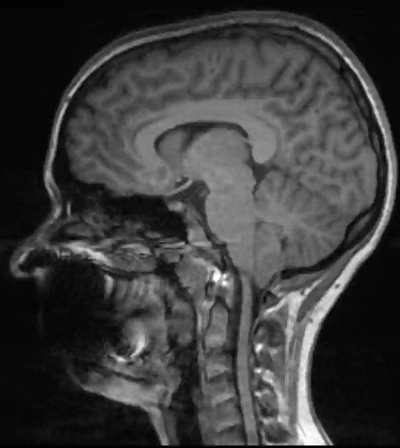 Chiari I Malformation im MRI