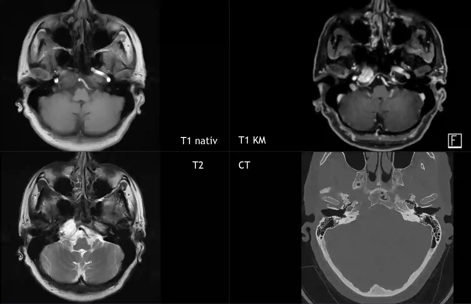 Chondrosarkom im MRI und CT