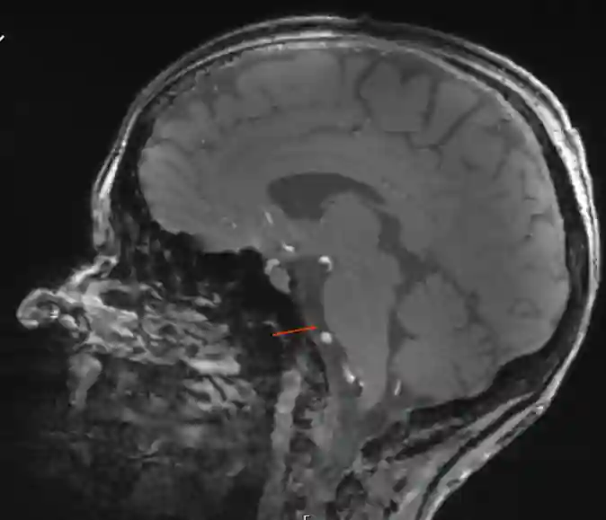 Cisterna pontis im MRI