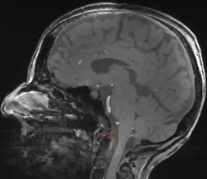 Darstellung der Cisterna premedullaris im MRI