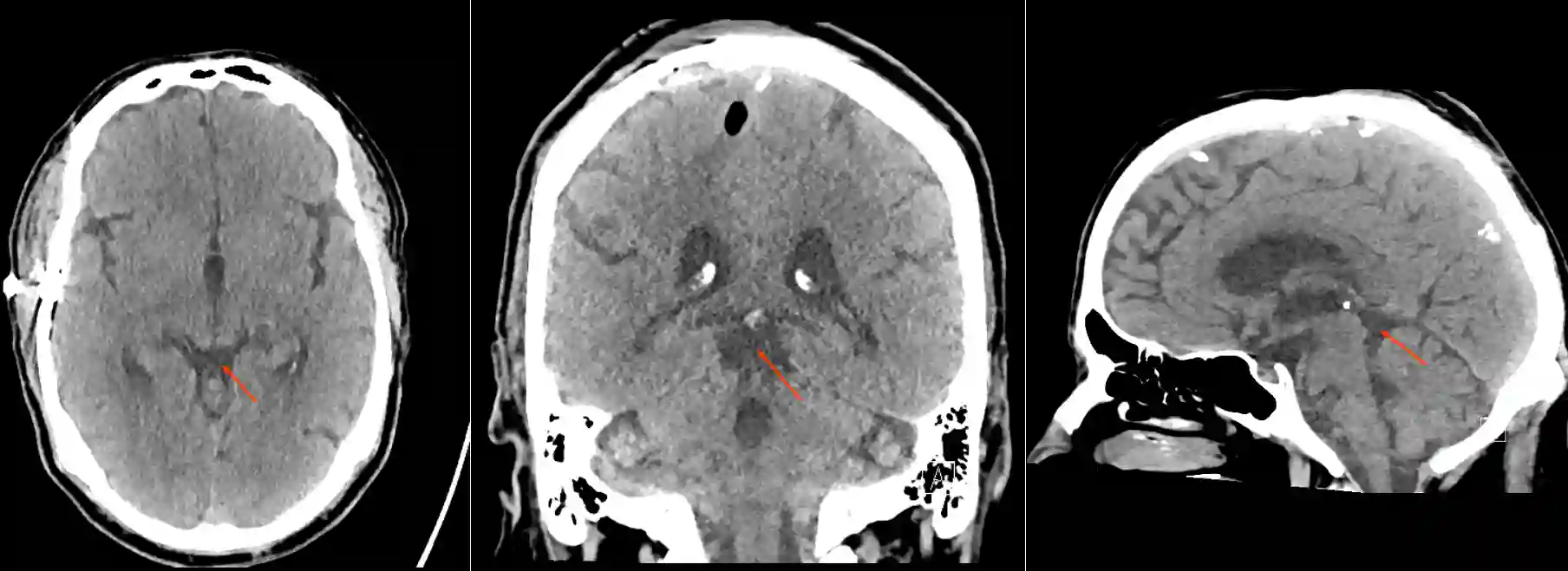 CT Cisterna quadrigeminalis