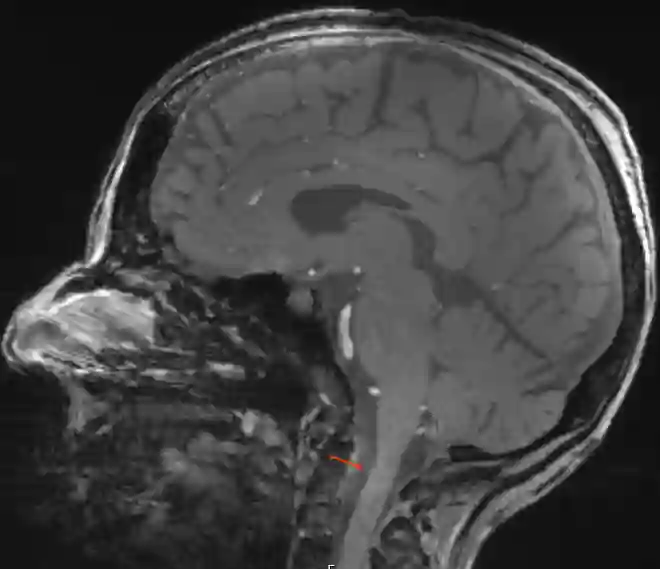 Cisterna spinalis anterior im MRI
