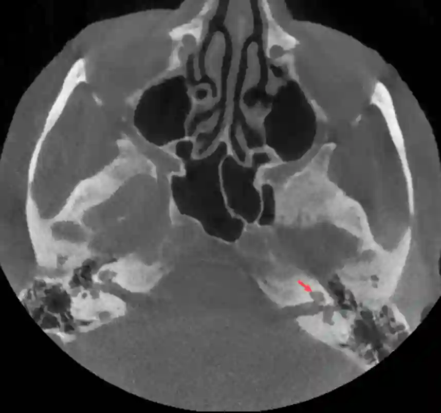 Cochlea im axialen CT Bild