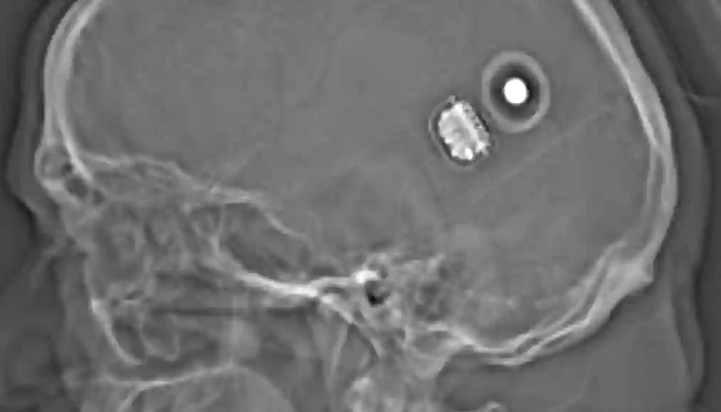 Abbildung eines CT Scout Bilds bei einem Patient mit einem Cochlea Implantat