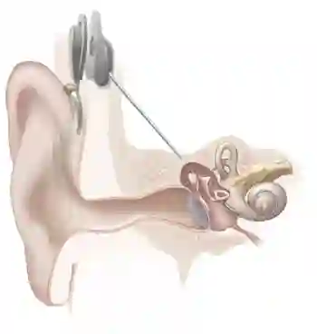 chematischer Aufbau eines Cochlea Implantats.