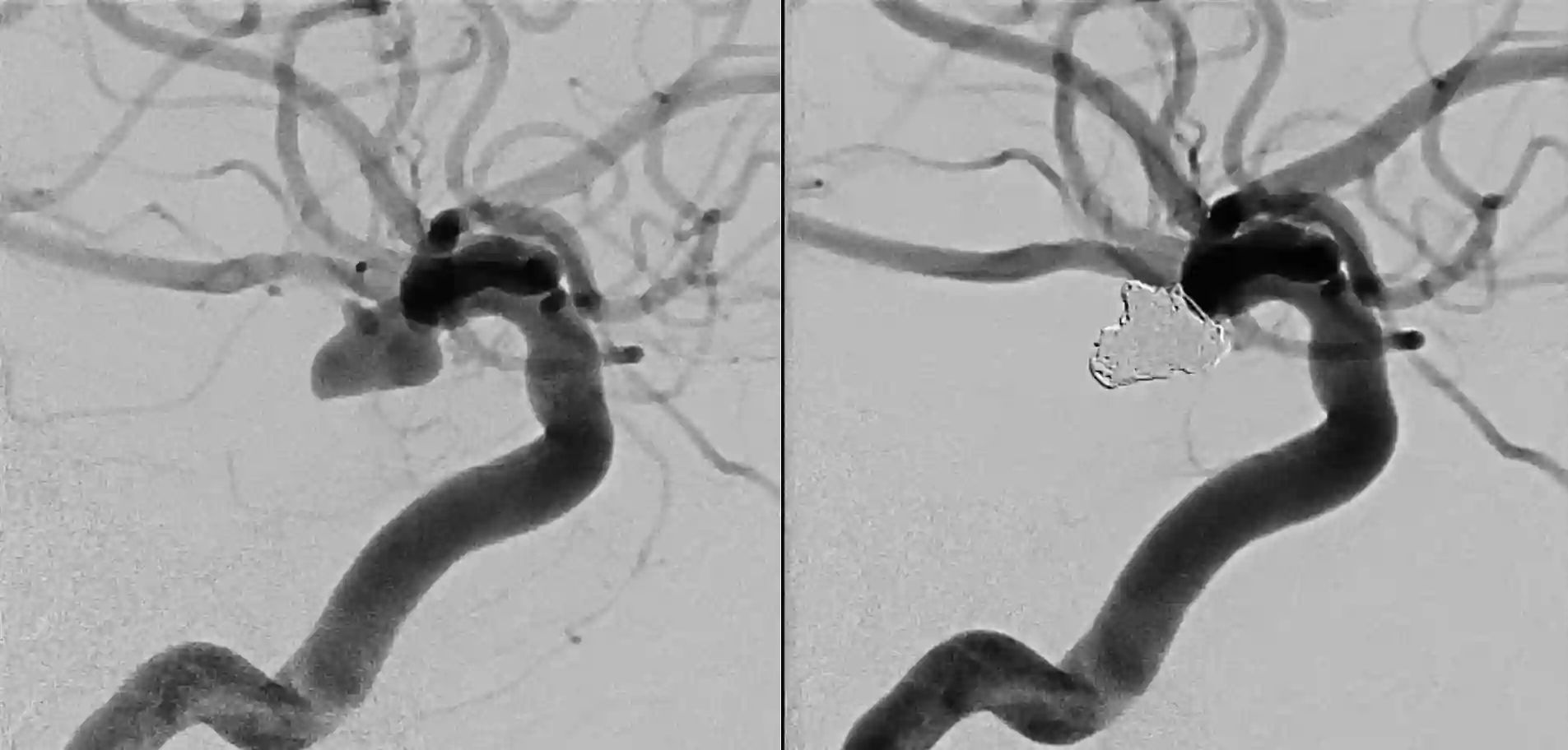 Coiling PCOM Aneurysma