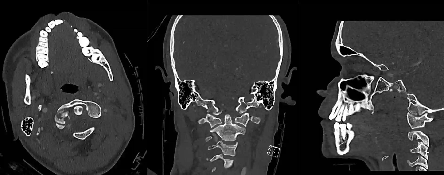 Condylus occipitalis Fraktur im CT