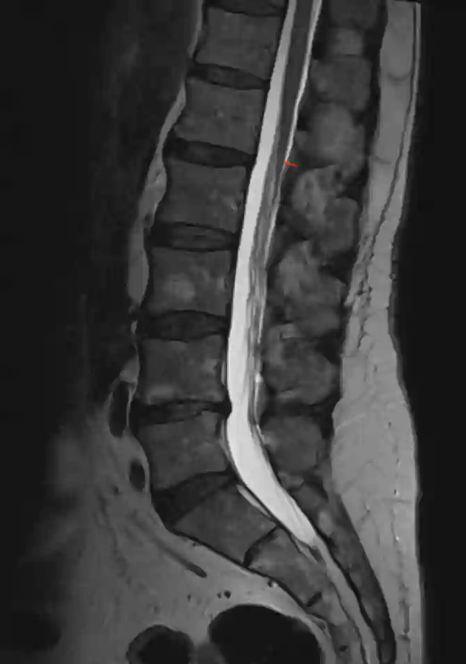 Conus medullaris MRI