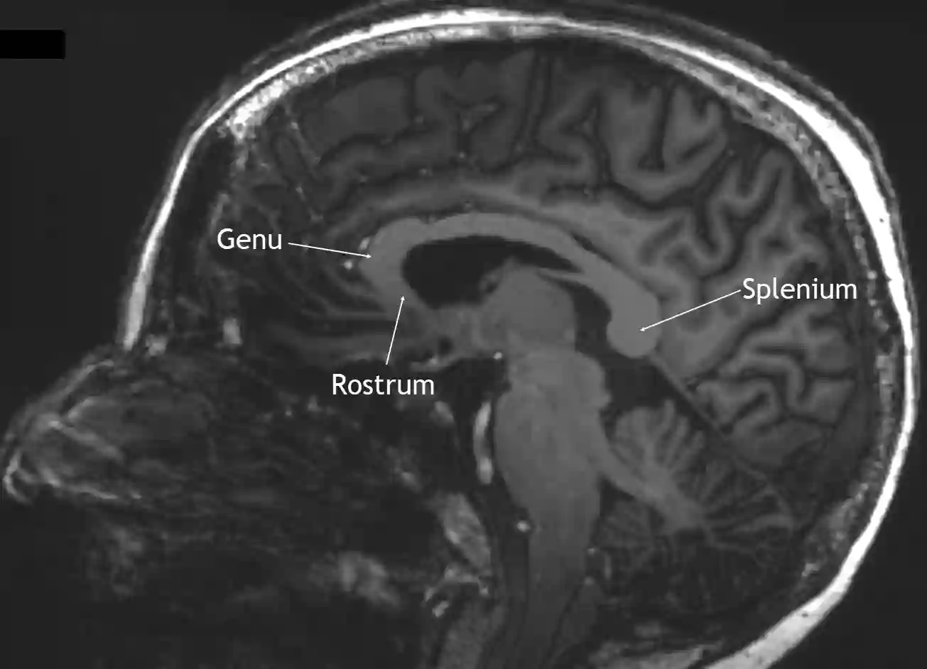 Corpus callosum im MRI