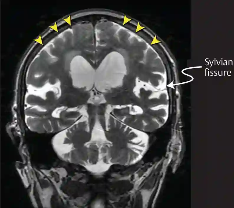 DESH MRI