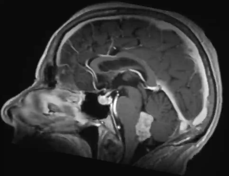 Ependymom MRI