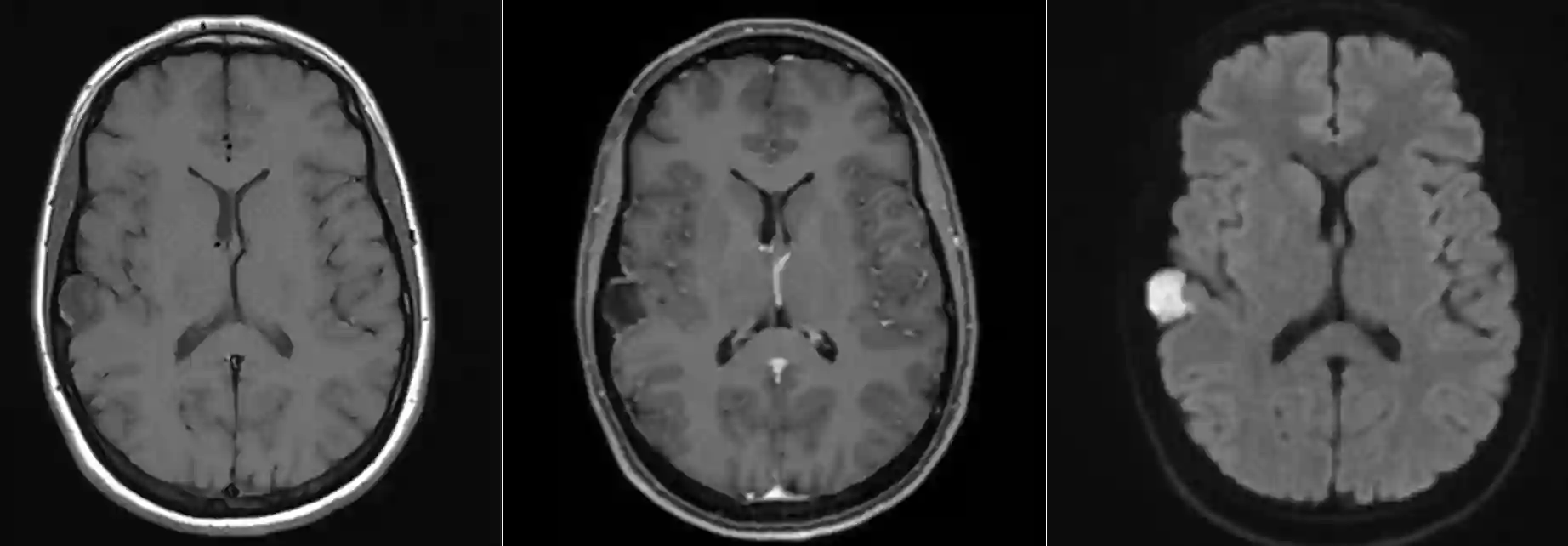 Epidermoid im MRI